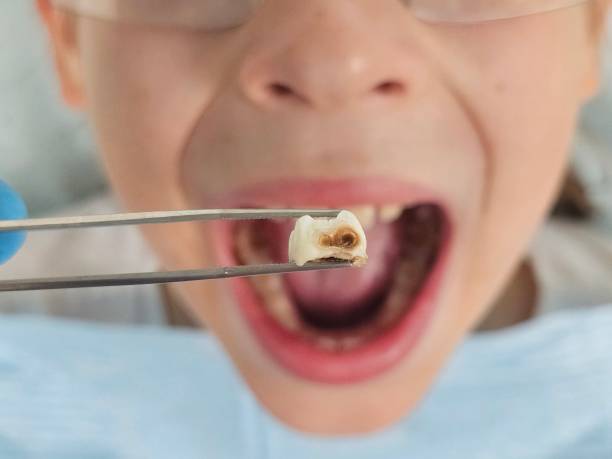 Best Emergency Dental Care for Broken or Chipped Teeth in Short Pump, VA